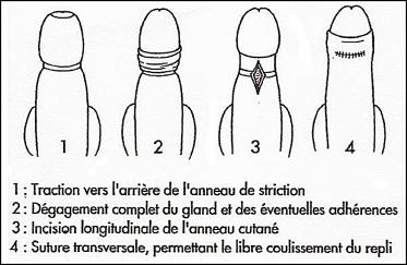 Les hommes sont-ils circoncis au Japon ?
