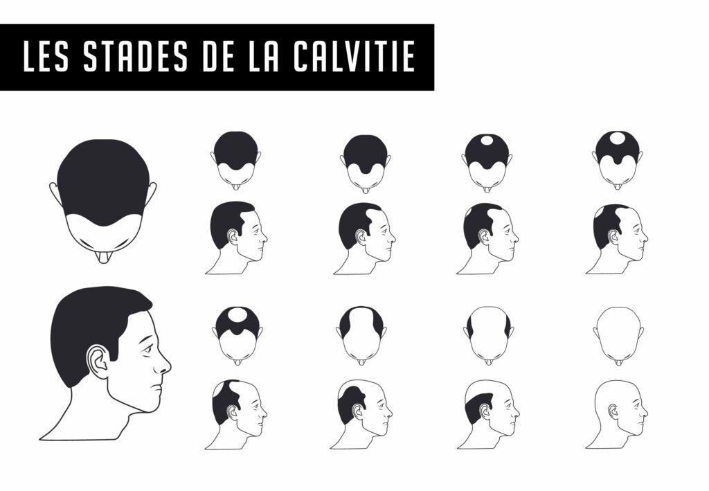 La calvitie est-elle courante au Japon ?